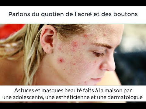 [PARENTS ADOS] ACNÉ : MASQUES MAISON et CONSEILS d'une adolescente, esthéticienne et dermatologue