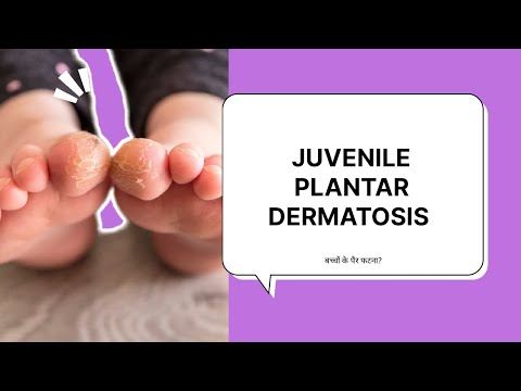 JUVENILE PLANTAR DERMATOSIS (छोटे बच्चों के पैर फटना, कारण और उपचार ) DRY & CRACK IN FEET OF CHILD !
