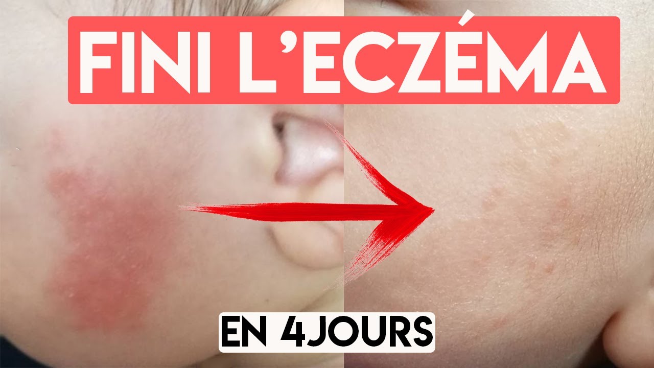 ECZÉMA ? LA SOLUTION NATURELLE & PAS CHÈRE 🙌