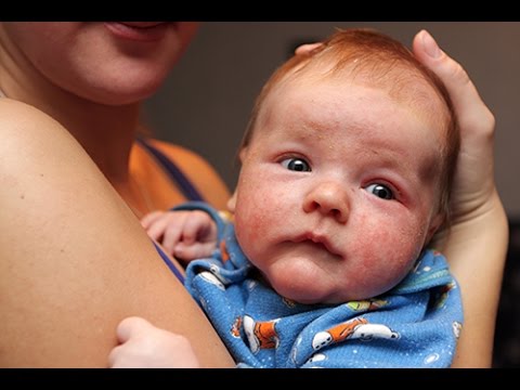 Eczéma : à partir de quel âge bébé peut-il en faire?