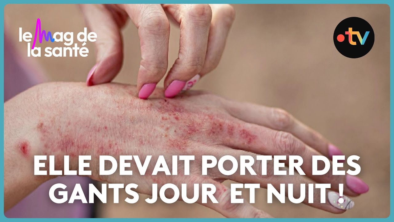 Nos conseils pour soigner l'eczéma
