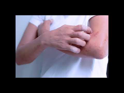 Eczéma  4 remèdes de grand mère