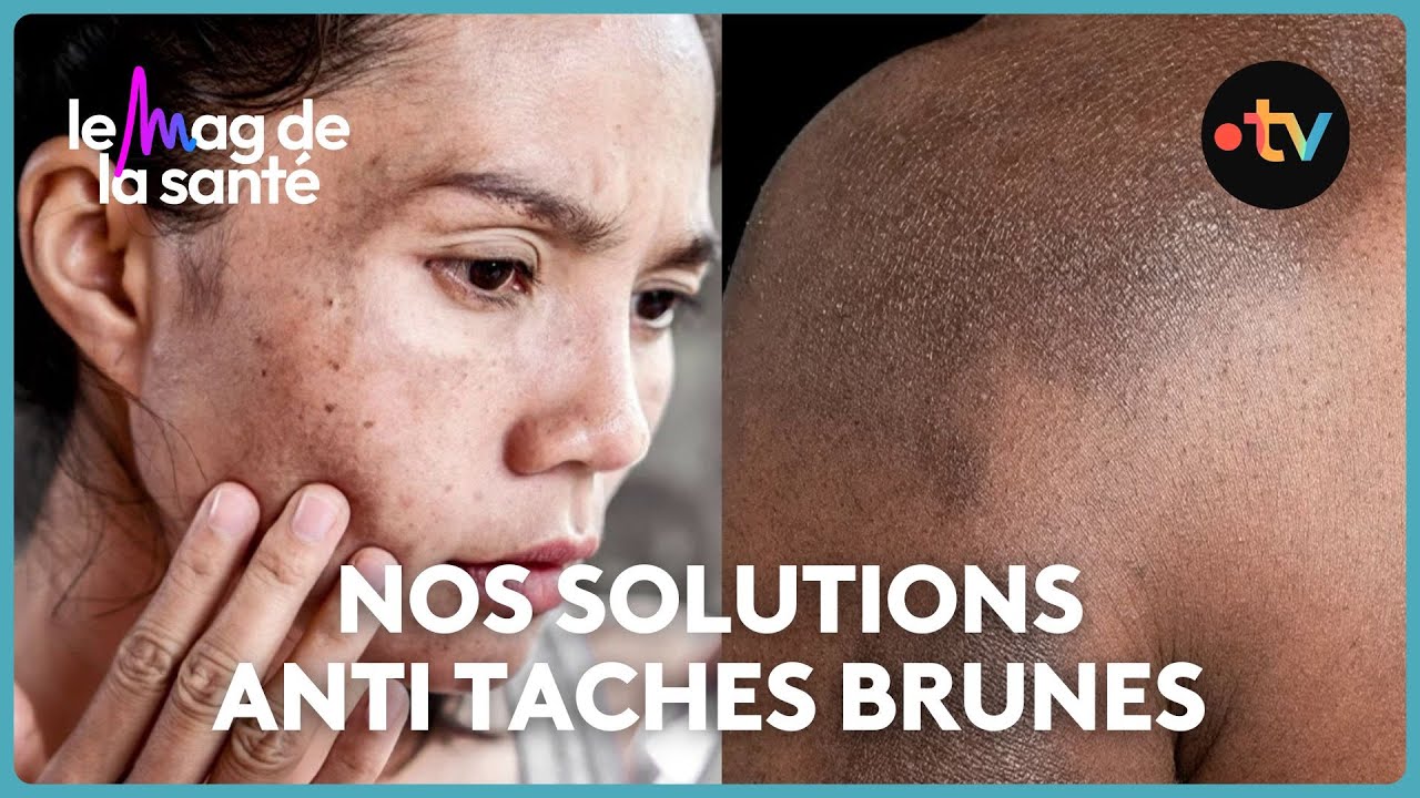 Hyperpigmentation de la peau : que faire en cas de taches brunes sur la peau ?