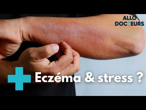 Eczéma : quelles solutions ? - Allo Docteurs