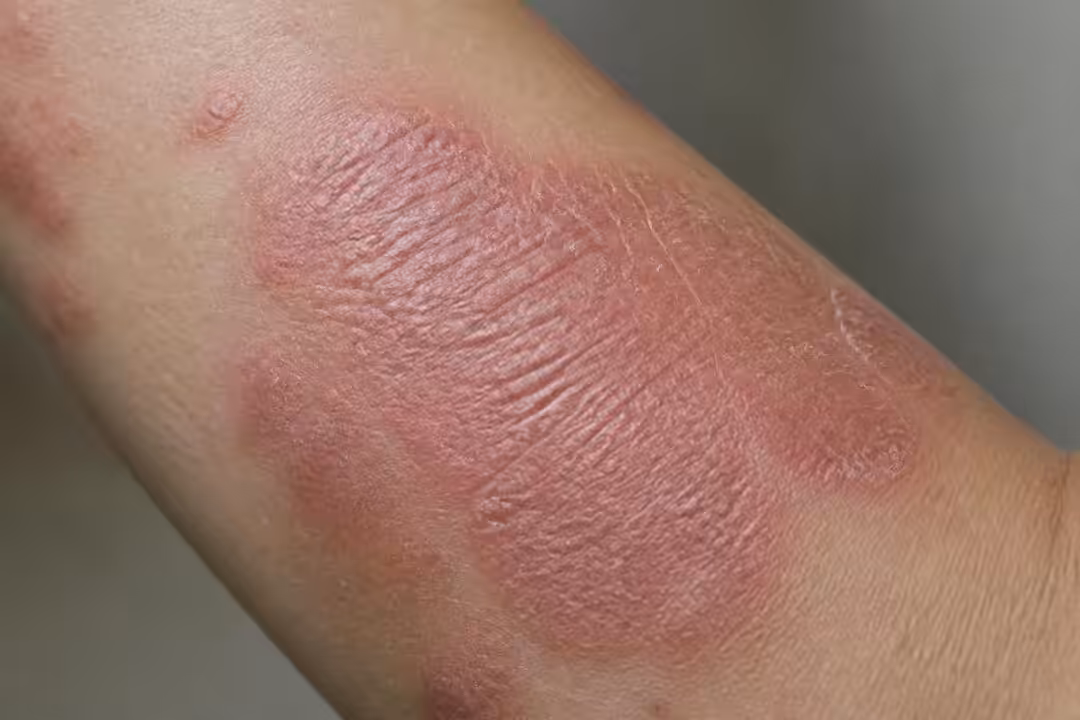 découvrez à quoi ressemble l'eczéma lichénifié, ses symptômes caractéristiques et comment le reconnaître pour mieux le traiter.