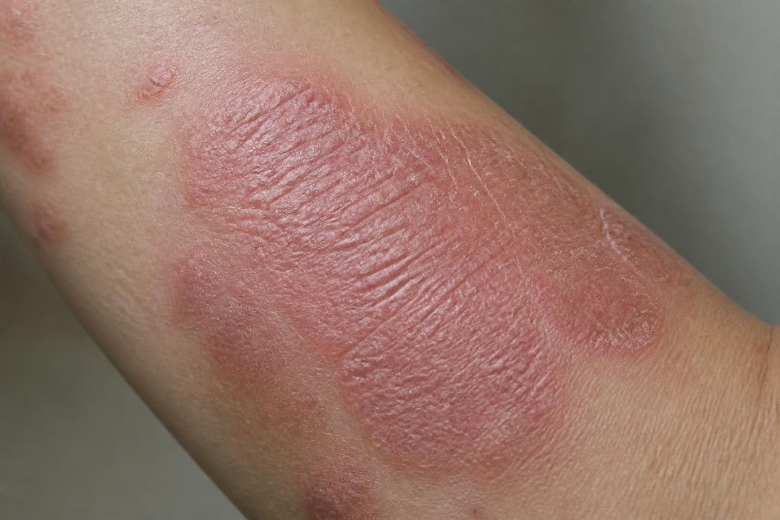 découvrez à quoi ressemble l'eczéma lichénifié, ses symptômes caractéristiques et comment le reconnaître pour mieux le traiter.