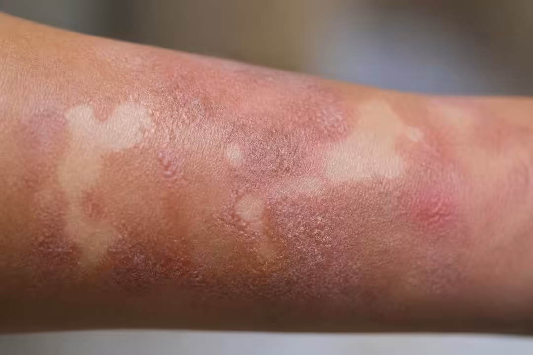 découvrez tout ce qu'il faut savoir sur la dépigmentation liée à l'eczéma, ses causes, ses symptômes et les solutions pour mieux la comprendre et la traiter.