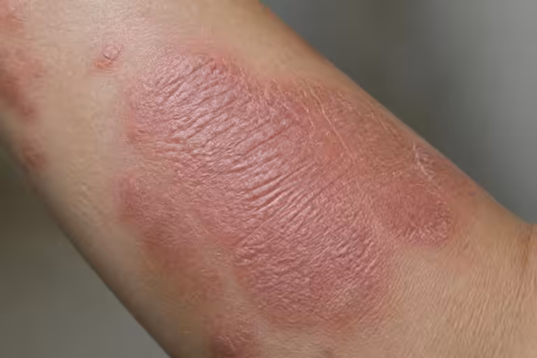 Eczéma lichénifié : à quoi ressemble cette forme