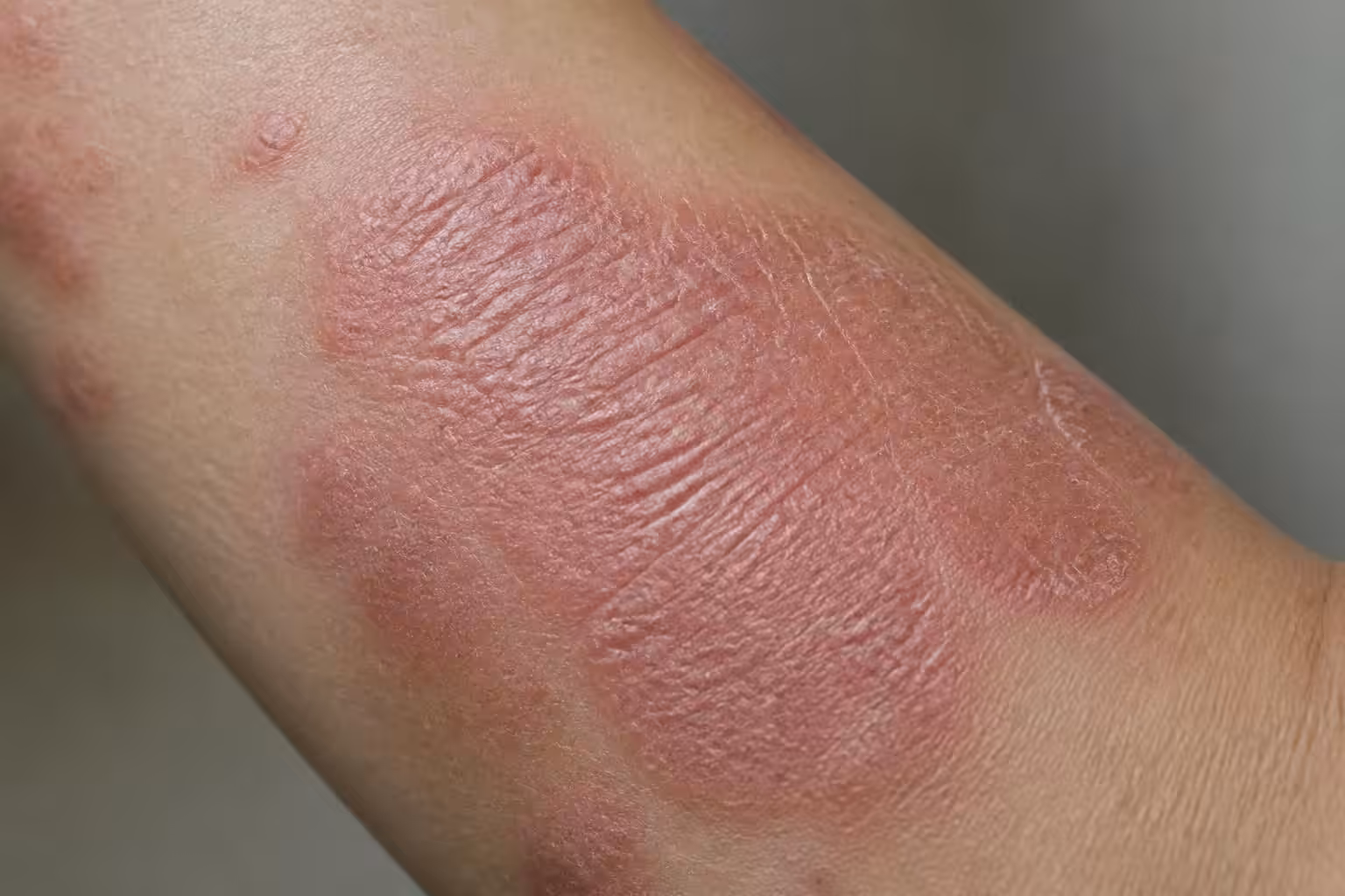 découvrez à quoi ressemble l'eczéma lichénifié, ses symptômes caractéristiques et comment le reconnaître pour mieux le traiter.